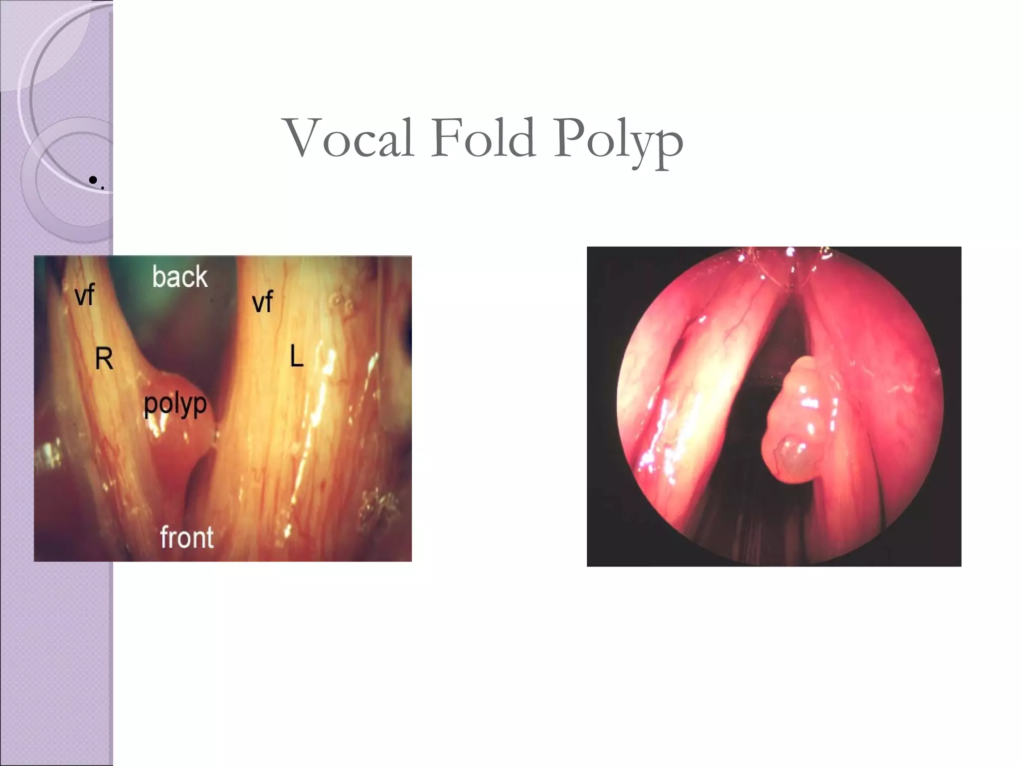 Vocal Fold Polyp .  