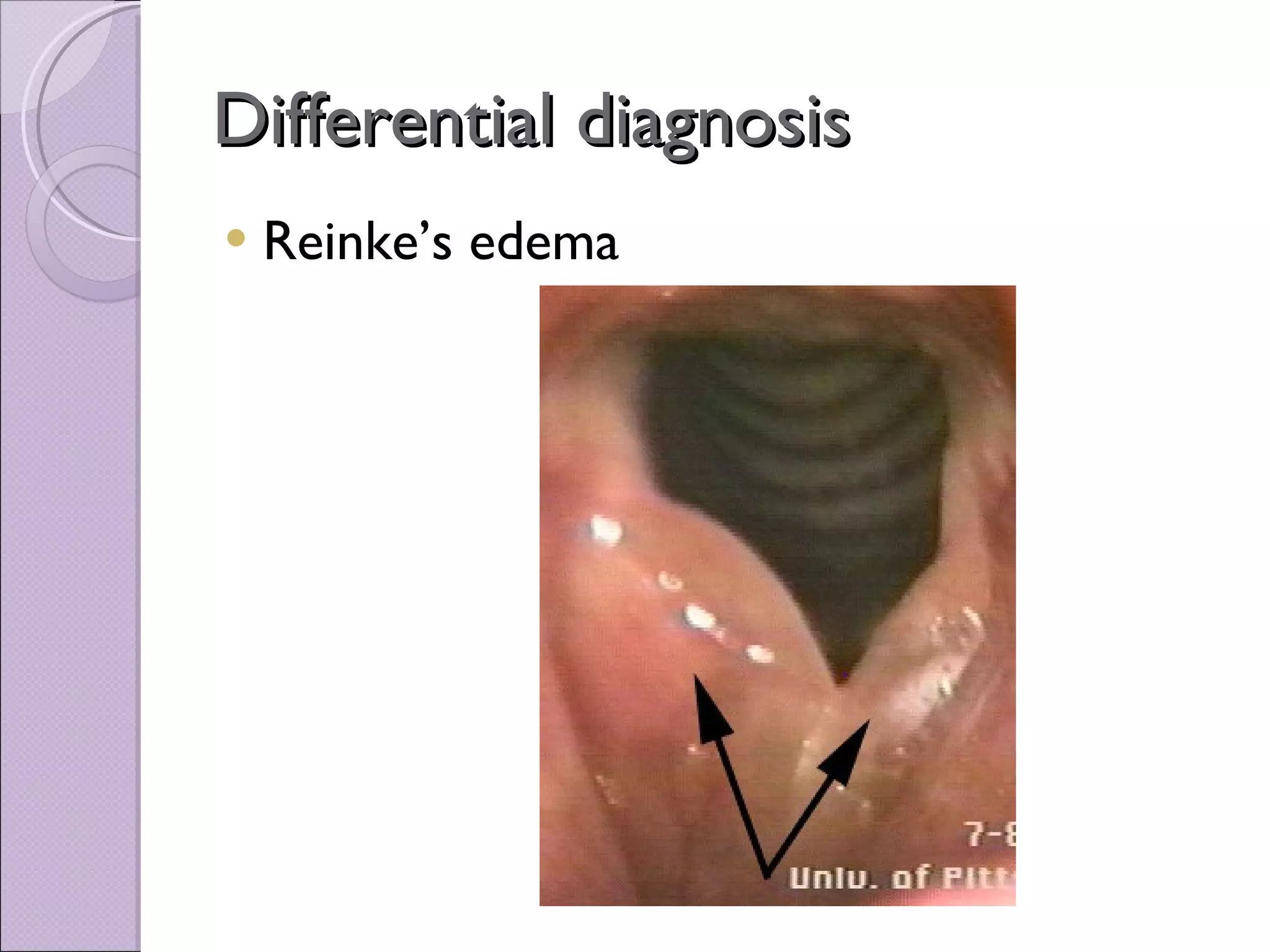 Differential diagnosis Reinke’s edema 