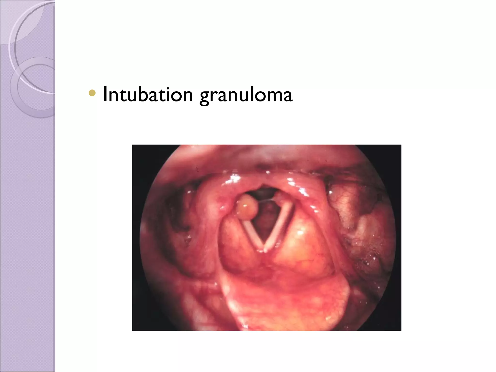Intubation granuloma 