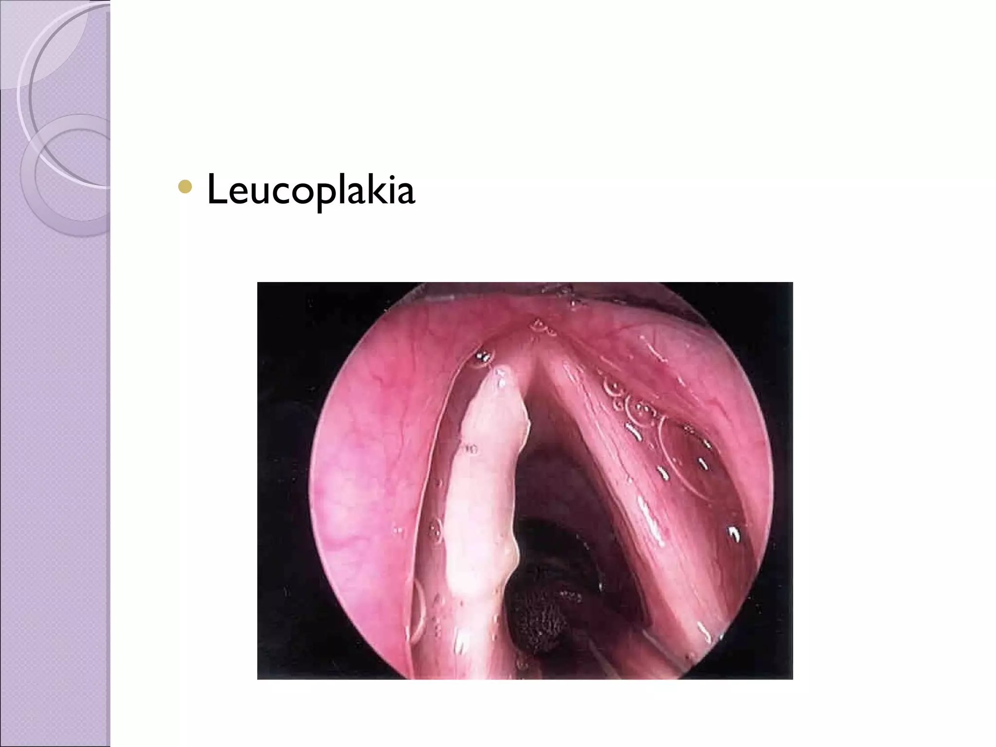 Leucoplakia 