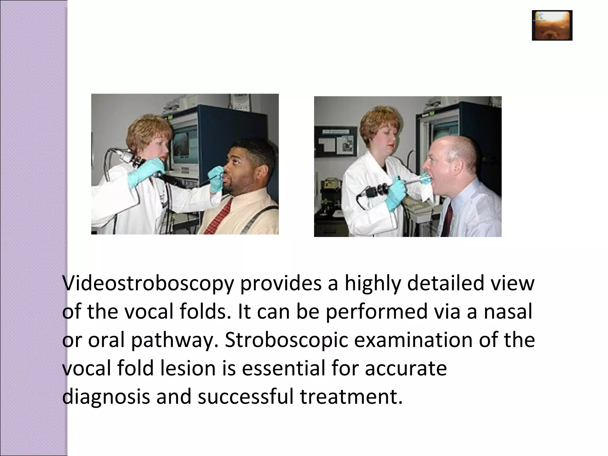 Videostroboscopy provides a highly detailed view of the vocal folds. It can be performed via a nasal or oral pathway.  Stroboscopic examination of the vocal fold lesion is essential for accurate diagnosis and successful treatment.   