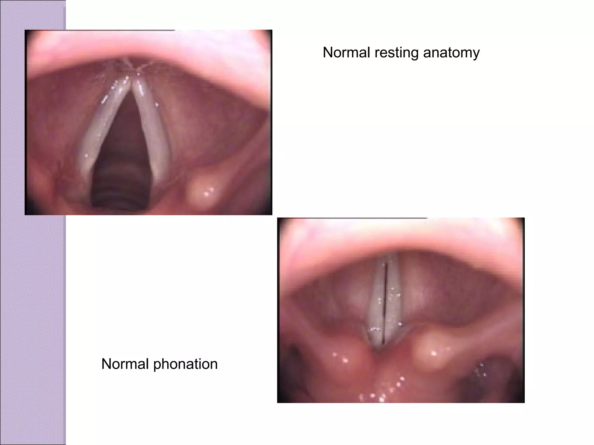 Normal resting anatomy Normal phonation 