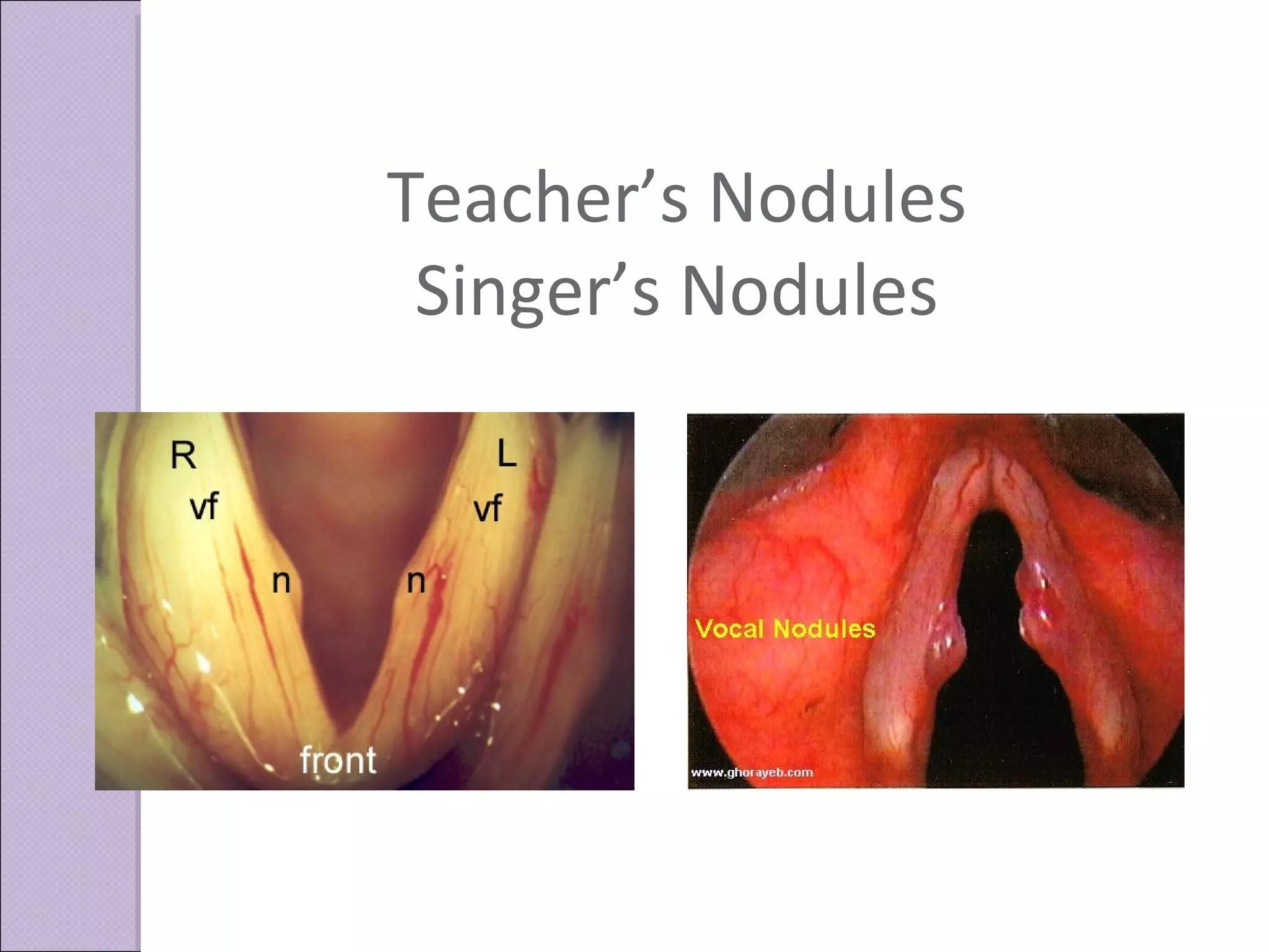 Teacher’s Nodules Singer’s Nodules 