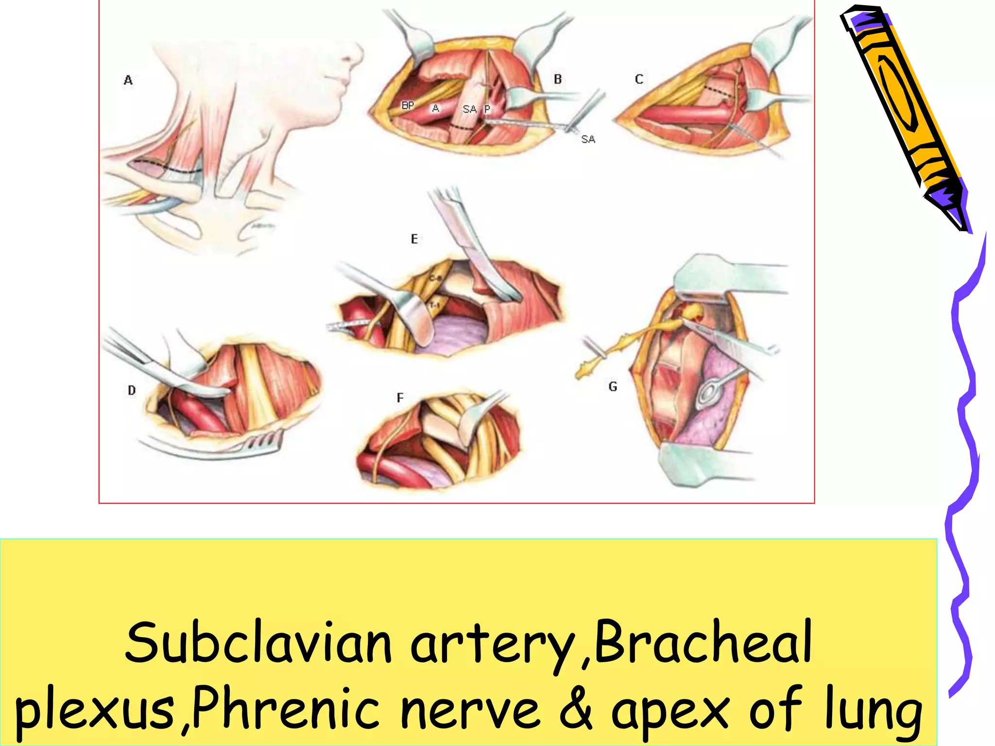 Symptomatic cervical rib surgery | PPT