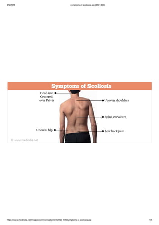 4/9/2018 symptoms-of-scoliosis.jpg (950×400)
https://www.medindia.net/images/common/patientinfo/950_400/symptoms-of-scoliosis.jpg 1/1
 