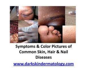 Symptoms & Color Pictures of Common Skin, Hair & Nail Diseases  www.darkskindermatology.com 