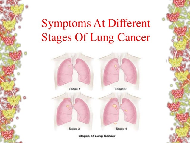 Stage 4 Lung Cancer >> Symptoms At Different Stages Of Lung Cancer Stage 4 Lung Cancer >> Symptoms At Different Stages Of Lung Cancer