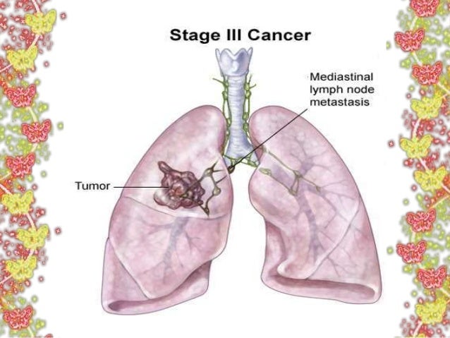 Symptoms at different stages of lung cancer