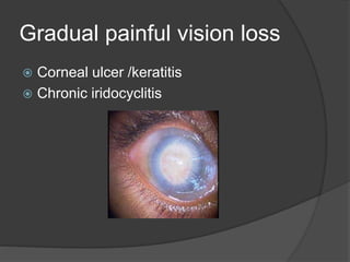 Gradual painful vision loss
 Corneal ulcer /keratitis
 Chronic iridocyclitis
 