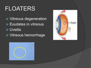 FLOATERS
 Vitreous degeneration
 Exudates in vitreous
 Uveitis
 Vitreous hemorrhage
 
