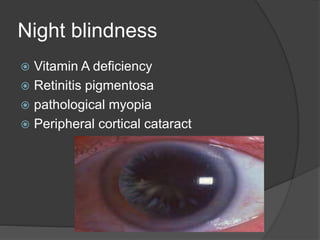 Night blindness
 Vitamin A deficiency
 Retinitis pigmentosa
 pathological myopia
 Peripheral cortical cataract
 