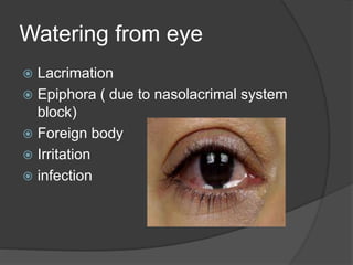 Watering from eye
 Lacrimation
 Epiphora ( due to nasolacrimal system
block)
 Foreign body
 Irritation
 infection
 
