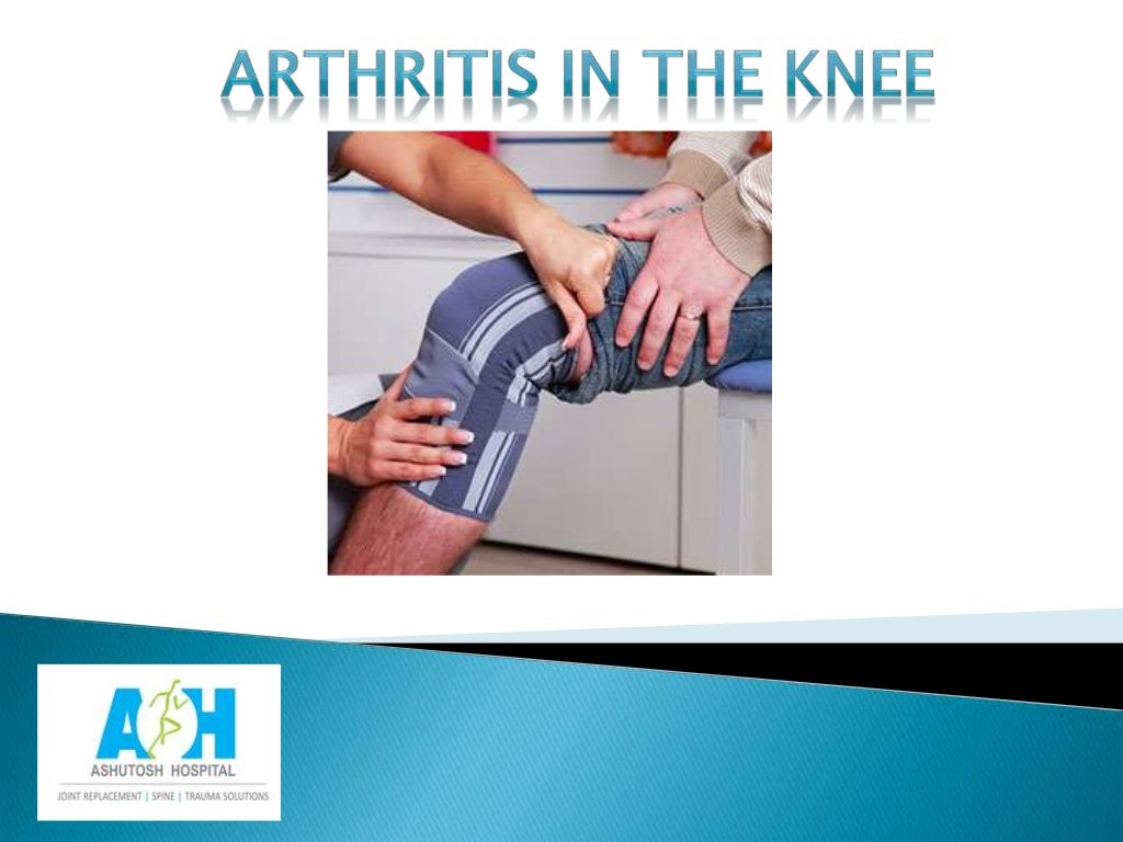 7 Symptoms of Arthritis in the Knee Orthopaedic Surgeon
