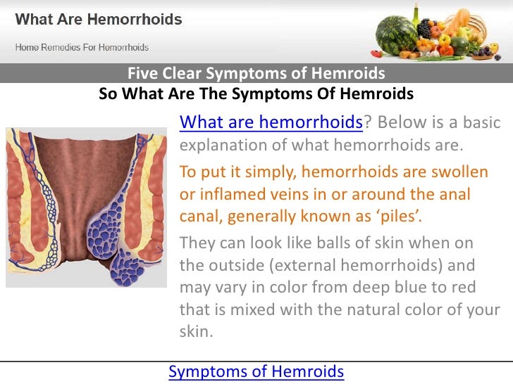 piles pictures and symptoms diagrams external hemorrhoids newhairstylesformen2014 piles pictures and symptoms diagrams external hemorrhoids newhairstylesformen2014