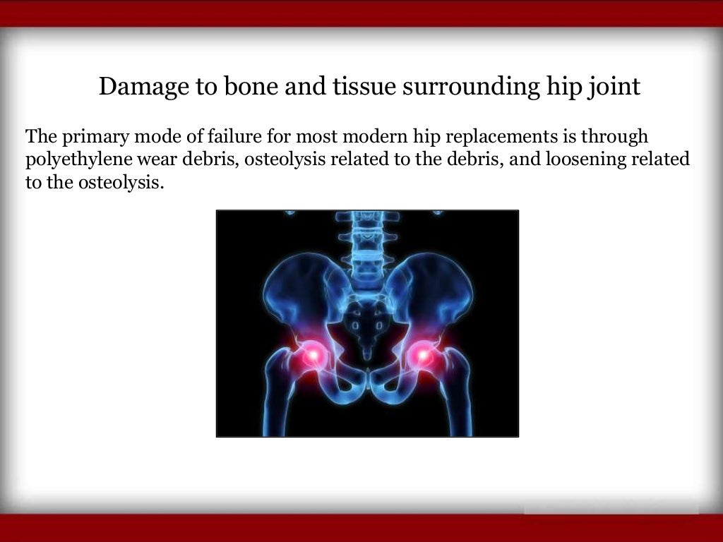 Symptoms of Hip Replacement Implant Recall