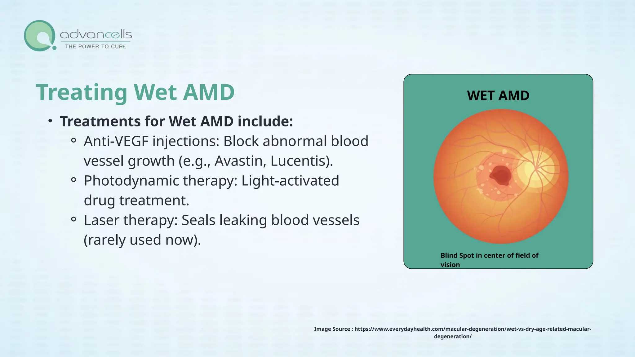 Symptoms of Macular Degeneration and Age-Related Macular Degeneration ...