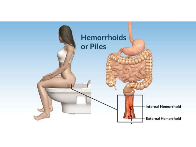 how to get rid of hemorrhoids naturally