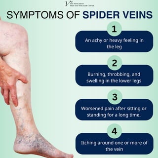 Worsened pain after sitting or
standing for a long time.
1
An achy or heavy feeling in
the leg
2
Burning, throbbing, and
swelling in the lower legs
3
4
Itching around one or more of
the vein
SYMPTOMS OF SPIDER VEINS
 