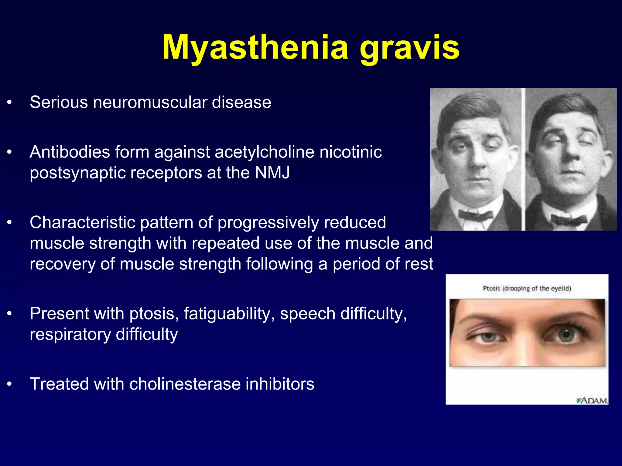 Myasthenia gravis
• Serious neuromuscular disease
• Antibodies form against acetylcholine nicotinic
postsynaptic receptors at the NMJ
• Characteristic pattern of progressively reduced
muscle strength with repeated use of the muscle and
recovery of muscle strength following a period of rest
• Present with ptosis, fatiguability, speech difficulty,
respiratory difficulty
• Treated with cholinesterase inhibitors
 