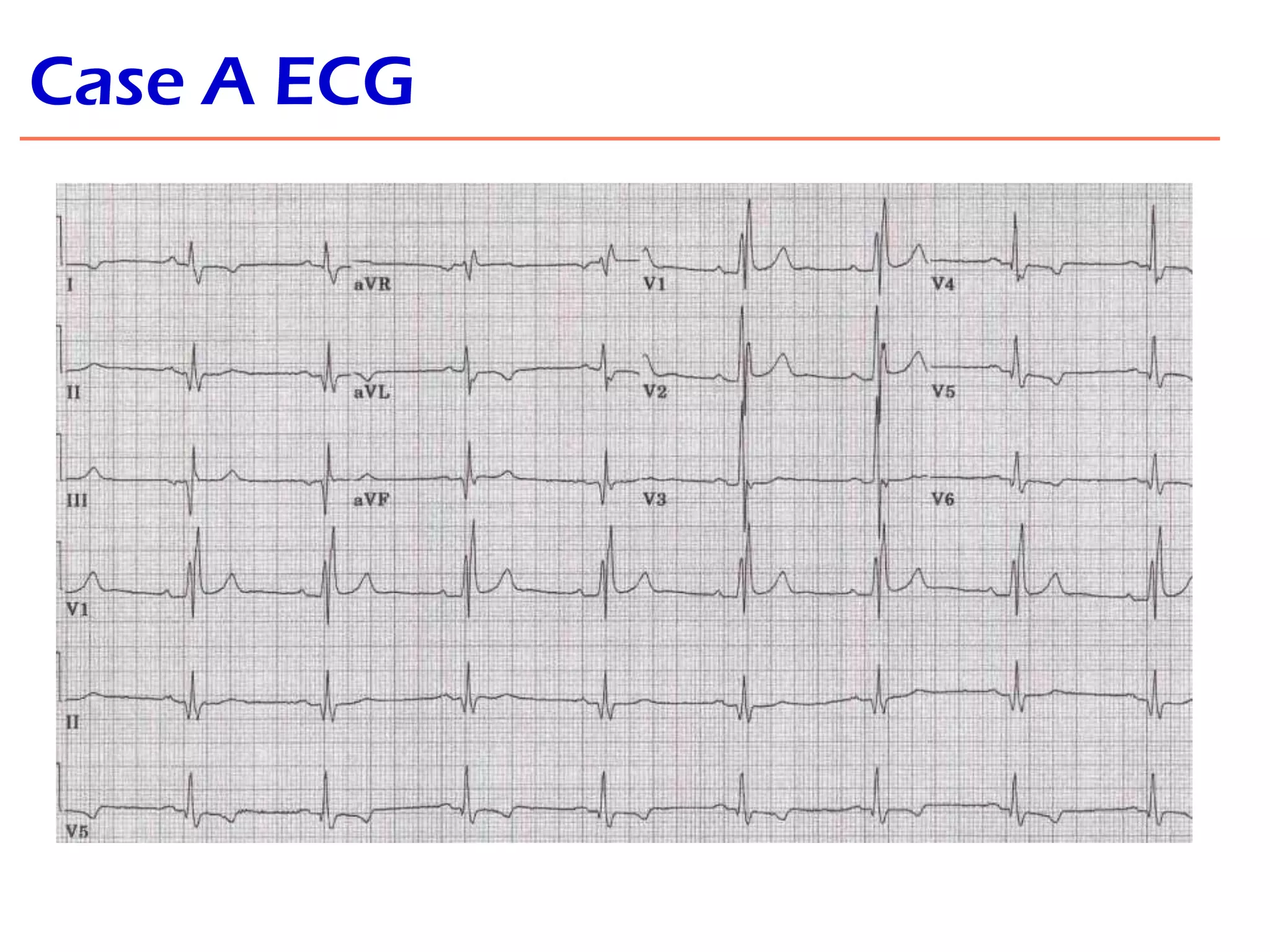 Case A ECG

 