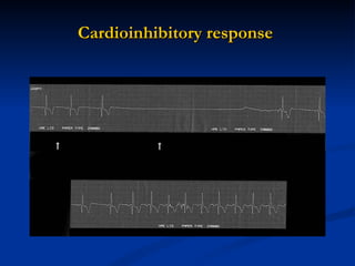 Cardioinhibitory response  