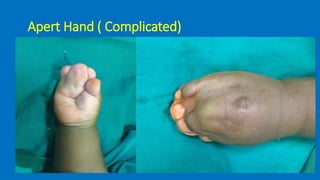 Syndactyly | PPTX