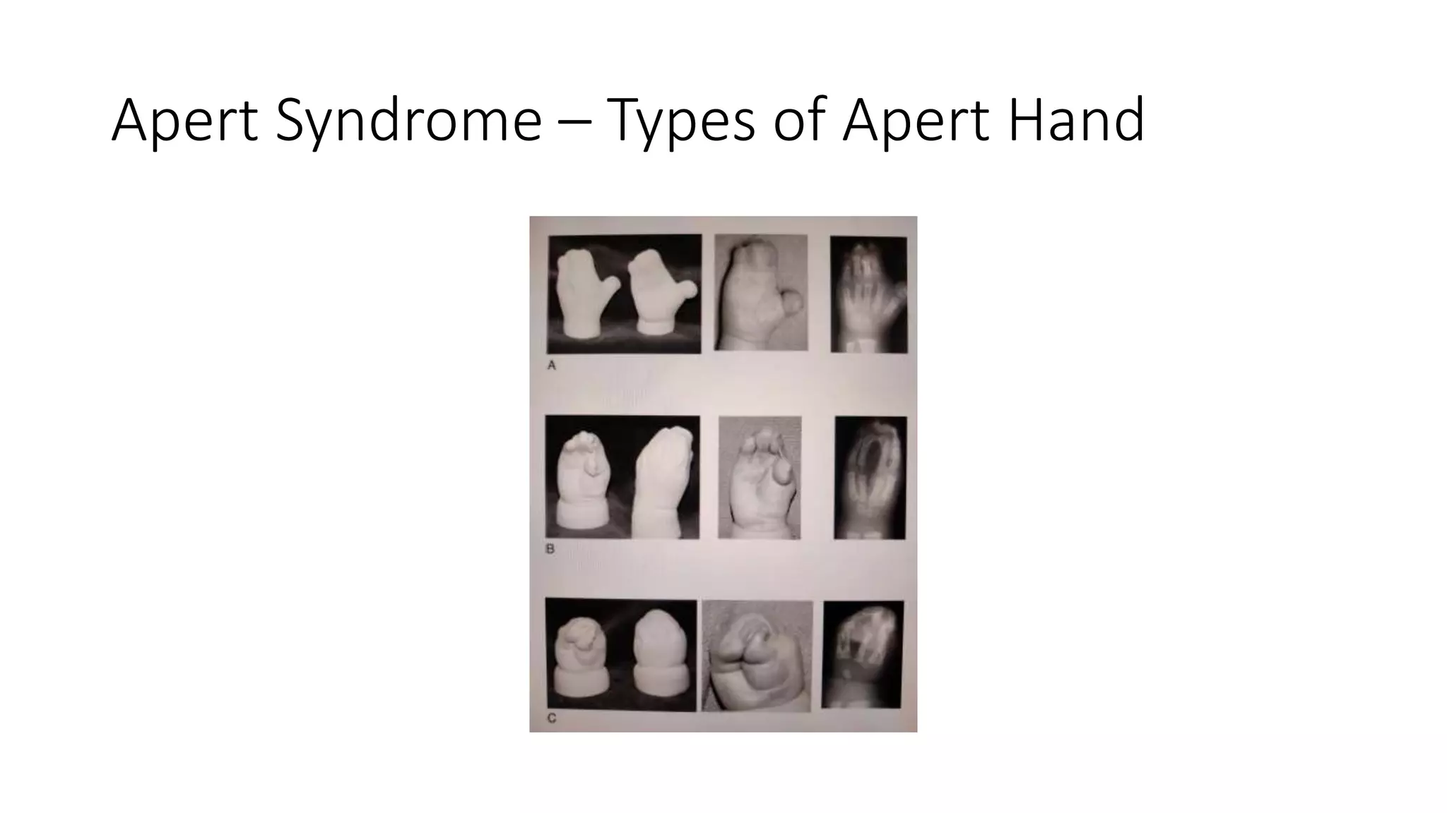 Syndactyly.pptx