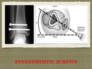 SYNDESMOSTIC SCREWS 
 