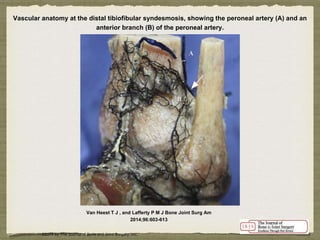 Vascular anatomy at the distal tibiofibular syndesmosis, showing the peroneal artery (A) and an 
anterior branch (B) of the peroneal artery. 
Van Heest T J , and Lafferty P M J Bone Joint Surg Am 
2014;96:603-613 
©2014 by The Journal of Bone and Joint Surgery, Inc. 
 