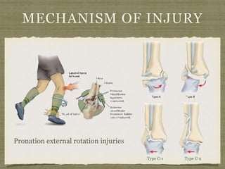 MECHANISM OF INJURY 
Type C-1 Type C-2 
Pronation external rotation injuries 
 