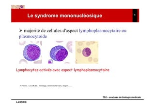 Le syndrome mononucléosique                                                      4




     majorité de cellules d'aspect lymphoplasmocytaire ou
  plasmocytoïde




Lymphocytes activés avec aspect lymphoplasmocytaire



    Photos : L.LOKIEC, bioimage, uniniversité tours, Angers……




                                                                TS2 – analyses de biologie médicale

L.LOKIEC
 