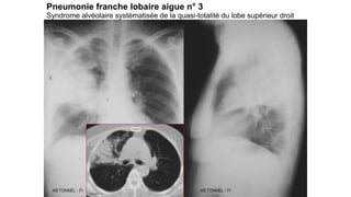 Bronchogramme aérique
visualisé sur le cliché agrandi
Pneumonie franche lobaire aigue n° 4
associé à un
épanchement
pleura...