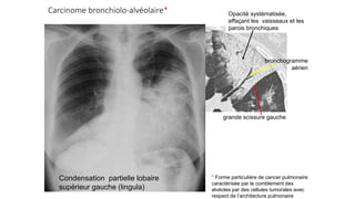 Pneumonie aigue virale
Opacités
• non systématisées
• bilatérales
• effaçant plus ou moins les vaisseaux
• contenant pour ...