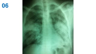 06• Anomalie radiologique bilatérale:
• A gauche: opacité en plage des deux tiers inférieurs du
champ pulmonaire dense hom...