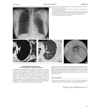 Radiodiagnostic Syndrome bronchique 32-360-C-10 
TRACHÉOBRONCHOMÉGALIE 
OU SYNDROME DE MOUNIER-KHUN 
Ce syndrome est caractérisé par une dilatation marquée de la trachée 
et des grosses bronches d’interruption brutale avec les voies 
aériennes plus périphériques qui sont normales. Les chiffres 
maximaux acceptables pour un adulte sont de 30 mm pour la 
trachée, 24 mm pour la bronche souche droite et 23 mm pour la 
gauche. Parfois associée à une anomalie congénitale du tissu de 
soutien, cette anomalie pourrait être favorisée par des 
barotraumatismes et une oxygénothérapie en période néonatale, le 
tabagisme, une suppuration chronique, sinusienne ou bronchique ; 
l’association à des dilatations des bronches est possible. 
23 Séquestration avec bronchectasies. 
A. La radiographie thoracique lors d’un épisode de surinfection d’une séquestration 
intralobaire supérieure gauche. 
B, C. La tomodensitométrie (TDM) avec angioscanner rapide (B) montre le départ des 
bronchiques en avant et l’artère séquestrante en arrière (têtes de flèches). Elle montre 
aussi (C) les dilatations des bronches et les dystrophies du territoire séquestré. 
D. Artériographie montrant l’artère anormale. 
On peut citer encore la trachéobronchopathie ostéochondroplastique, 
affection rare, connue chez des patients BPCO et rapprochée des 
dépôts amyloïdes. Les cartilages trachéobronchiques sont calcifiés 
mais de façon longitudinale et non annulaire. Le « crissement » du 
fibroscope est typique. Des dilatations des bronches peuvent être 
associées (fig 24). 
Conclusion 
Le concept de syndrome bronchique vient de la période radiologique 
standard. Il doit être actualisé à l’heure de la TDM omniprésente. 
Figure 24 et Références ä 
*A 
*D 
*B *C 
15 
 