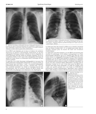 32-360-C-10 Syndrome bronchique Radiodiagnostic 
Si les BPCO sont dépistées par la mise en évidence du syndrome 
obstructif en épreuve fonctionnelle respiratoire et qu’une 
radiographie thoracique normale n’élimine en rien le diagnostic, le 
cliché thoracique doit être réalisé en première intention, lors de la 
consultation initiale. Il doit s’agir d’une radiographie thoracique de 
qualité (en haute tension ou numérisée) dont la technique est bien 
connue à présent. 
Il s’agit bien d’un cliché thoracique (radiographie) et non pas d’un 
cliché pulmonaire (radiographie pulmonaire). Un mauvais cliché, en 
basse tension (qui croit mieux « sortir » le poumon [radiographie 
pulmonaire]) peut faire croire à un faux « poumon sale » ou à un 
faux syndrome interstitiel. Les clichés en expiration doivent être 
systématiques chez les patients atteints de BPCO (étude des 
hyperclartés, des piégeages, de la distension et du diaphragme). 
3 Syndrome bronchique en radiographie thoracique. Distension thoracique avec ho-rizontalisation 
des coupoles ; aspect en « rail » des parois bronchiques des lobes infé-rieurs 
(étoiles) ; majoration d’épaisseur pariétale bronchique avec l’aspect A2B2 dit en 
« jumelle borgne » (flèches). 
Le cliché peut donc être normal au début ou au contraire caricatural 
dans les formes évoluées (fig 3, 4). Le malade peut entrer dans la 
maladie clinique plus ou moins tôt dans son évolution 
morphologique. 
Le cliché peut aussi être trompeur, car une BPCO sous-jacente peut 
modifier la sémiologie d’un oedème cardiogénique ou d’une 
pneumopathie infectieuse (qui ne se réalisent que dans les zones 
restées saines). La radiographie thoracique des BPCO peut être aussi 
trompeuse, car une BPCO peut prendre le masque d’un syndrome 
interstitiel alors que le cliché est bien fait (emphysème et dilatation 
des bronches peuvent mimer en partie le syndrome interstitiel) ou 
encore d’un faux syndrome hilaire (déformation vasculaire chez le 
distendu). Comme on le voit, il faut donc pour les BPCO une 
imagerie bien faite et bien interprétée. Au stade de la TDM, il faut 
exiger une qualité parfaite avec une étude en TDM-HR du 
parenchyme (coupes millimétriques, algorithme sharp, fenêtres 
larges, petits champs et matrices élevées). Le plus souvent, l’injection 
1 Syndrome bronchique en radiographie thoracique. Radiographie thoracique de face 
présentant des signes de distension pulmonaire avec visualisation et déplacement des 
lignes médiastinales commissurales (triples têtes de flèches) et un trouble ventilatoire 
collapsique en lobaire inférieur gauche (étoile, doubles flèches). 
2 Syndrome bronchique en ra-diographie 
thoracique. 
Radiographies thoraciques de face 
(A) et de profil (B) présentant une 
visualisation en « rails » épaissis 
des parois bronchiques de la pyra-mide 
basale gauche dont l’éventail 
est anormalement resserré de profil 
(têtes de flèches). On note un as-pect 
dit en « rayon de miel » loca-lisé 
de la base droite lié à d’éven-tuelles 
dilatations des bronches 
(étoile) que l’on retrouve de profil 
en lobaire moyen. 
*A *B 
2 
 
