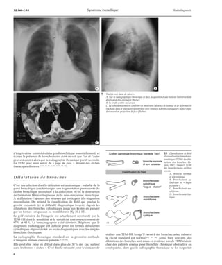 32-360-C-10 Syndrome bronchique Radiodiagnostic 
*A *B 
d’emphysème (centrolobulaire postbronchitique essentiellement) et 
écarter la présence de bronchectasies dont on sait que l’un et l’autre 
peuvent exister alors que la radiographie thoracique paraît normale. 
La TDM peut ainsi servir de « juge de paix » devant des clichés 
thoraciques douteux [3, 31, 35, 37, 46, 47, 49, 51, 55, 56]. 
Dilatations de bronches 
C’est une affection dont la définition est anatomique : maladie de la 
paroi bronchique caractérisée par une augmentation permanente du 
calibre bronchique secondaire à la dislocation et/ou la destruction 
de l’armature fibrocartilagineuse de la sous-muqueuse bronchique. 
À la dilatation s’ajoutent des sténoses qui participent à la stagnation 
mucociliaire. On retiend la classification de Reid qui gradue la 
gravité croissante (et la difficulté diagnostique inverse) depuis les 
dilatations des bronches cylindriques jusqu’aux kystes en passant 
par les formes variqueuses ou moniliformes (fig 10 à 12). 
Le gold standard de l’imagerie est actuellement représenté par la 
TDM-HR dont la sensibilité et la spécificité sont respectivement de 
97 % et 93 %. La bronchographie a été détrônée. Répétons que le 
diagnostic radiologique est difficile pour les formes débutantes 
cylindriques et pour éviter les excès diagnostiques avec les simples 
bronchites chroniques. 
La radiographie thoracique standard est la première méthode 
d’imagerie réalisée chez ces patients [3, 25, 26]. 
Elle peut être prise en défaut dans plus de 30 % des cas, surtout 
dans les formes « sèches ». C’est dire la nécessité pour le clinicien de 
9 Trachée en « lame de sabre ». 
A. Sur la radiographique thoracique de face, la question d’une tumeur latérotrachéale 
droite peut être envisagée (flèche). 
B. Le profil semble rassurant. 
C. La tomodensitométrie confirme en montrant l’absence de tumeur et de déformation 
trachéale dans le plan antéropostérieur avec rotation à droite expliquant l’aspect pseu-dotumoral 
en projection de face (flèches). 
réaliser une TDM-HR lorsqu’il pense à des bronchectasies, même si 
le cliché standard est normal [15, 27, 38]. Ainsi, bien souvent, des 
dilatations des bronches sont mises en évidence lors de TDM réalisée 
chez des patients connus pour bronchite chronique obstructive ou 
emphysème, alors que la radiographie thoracique ne les suspectait 
*C 
TDM en pathologie bronchique Marseille 1997 
Bronche normale 
et son vaisseau 
Classification de Reid 
Bronchectasie 
cylindrique 
"bague chaton" 
Bronchectasie 
moniliforme 
Bronchectasie 
kystique 
10 Classification de Reid 
et visualisation tomodensi-tométrique 
(TDM) des dila-tations 
des bronches. De-puis 
1987, l’aspect TDM 
des bronchectasies est bien 
connu. 
A. Bronche normale 
et son vaisseau. 
B. Bronchectasie cy-lindrique 
en « bague 
à chaton ». 
C. Bronchectasie mo-niliforme. 
D. Bronchectasie kys-tique. 
6 
 