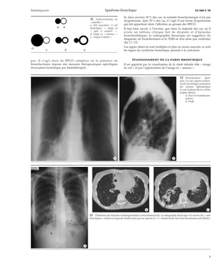 Radiodiagnostic Syndrome bronchique 32-360-C-10 
pas. Il s’agit alors de BPCO complexe où la présence de 
bronchectasies impose des mesures thérapeutiques spécifiques 
(évacuation bronchique par kinésithérapie). 
Si, dans environ 30 % des cas, la maladie bronchectasique n’est pas 
dyspnéisante, dans 70 % des cas, il s’agit d’une forme dyspnéisante 
qui fait appartenir alors l’affection au groupe des BPCO. 
Il faut bien savoir, à l’inverse, que dans la majorité des cas où il 
existe un tableau clinique fait de dyspnée et d’épisodes 
bronchorrhéiques, la radiographie thoracique est suggestive du 
diagnostic de bronchectasies et la TDM ne fera alors que confirmer 
(fig 12, 13). 
Les signes observés sont multiples et plus ou moins associés, ce sont 
les signes du syndrome bronchique, poussés à la caricature. 
ÉPAISSISSEMENT DE LA PAROI BRONCHIQUE 
Il est apprécié par la visualisation de la clarté tubulée dite « image 
en rail » et par l’appréciation de l’image en « anneau ». 
a b 
c d e 
11 Artère et bronche : les 
« jumelles ». 
a. OEil vasculaire ; b. oeil 
bronchique ; c. image en 
« pain à cacheter » ; 
d. image en « anneau » ; 
e. « bague à chaton ». 
12 Bronchectasies kysti-ques. 
Les sacs, kystes en diver-ticules 
bronchiques présentent 
des niveaux hydroaériques 
et sont évidents dès les clichés 
simples (flèche). 
A. Face (en tomodensito-métrie). 
B. Profil. 
*A *B 
** * 
** 
13 Dilatations des bronches multisegmentaires et bronchomucocèle. La radiographie thoracique (A) montre des « rails 
bronchiques » à droite et à gauche (étoiles) ainsi qu’une opacité en « V » basale droite liée à une bronchomucocèle (flèche). 
*A 
*B *C 
7 
 