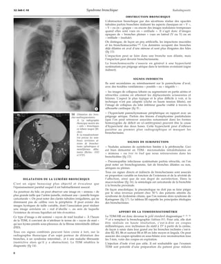 32-360-C-10 Syndrome bronchique Radiodiagnostic 
DILATATION DE LA LUMIÈRE BRONCHIQUE 
C’est un signe beaucoup plus objectif et évocateur que 
l’épaississement pariétal auquel il est habituellement associé. 
Au pourtour du hile, on peut observer une image en « anneau » de 
plus grande taille que l’artère jumelle, réalisant une « jumelle borgne 
caricaturale ». On peut noter des clartés tubulées irrégulières, qui ne 
diminuent pas de calibre vers la périphérie. Il peut exister des 
images kystiques de taille variable, dont l’association peut réaliser 
une image aréolaire en « nid d’abeille », au sein de laquelle 
l’existence de niveau liquidien est très évocatrice. 
Ce type d’image a été nommé « rayon de miel localisé ». À l’heure 
de la TDM, il convient de n’attribuer le terme de « rayon de miel » 
qu’aux kystes jointifs sous-pleuraux de la fibrose interstitielle diffuse 
(FID). 
Tous ces signes combinés peuvent faire croire à tort, sur la 
radiographie thoracique d’un sujet porteur de dilatation des 
bronches, à un syndrome interstitiel... et à une maladie fibrosante 
(restrictive alors qu’il y a obstruction). La TDM rétablira le 
diagnostic (fig 14). 
OBSTRUCTION BRONCHIQUE 
L’obstruction bronchique par des sécrétions réalise des opacités 
tubulées parfois branchées réalisant les aspects classiques en « V », 
« Y » ou en « grappe » ou encore des images nodulaires trompeuses 
quand elles sont vues en « enfilade ». Il s’agit donc d’images 
opaques de « bronches pleines » vues en latéral (V ou Y) ou en 
« enfilade » (nodule). 
On distingue, de façon un peu artificielle, les impactions mucoïdes 
et les bronchomucocèles [15]. Ces dernières occupent des bronches 
déjà dilatées en aval d’une sténose et sont plus éloignées des hiles 
(fig 13). 
L’impaction peut se faire dans une bronche non dilatée, mais 
l’impaction peut devenir bronchectasiante. 
La bronchomucocèle s’associe en général à une hyperclarté 
systématisée par piégeage aérique dans le territoire avoisinant (signe 
indirect). 
SIGNES INDIRECTS 
Ils sont secondaires au retentissement sur le parenchyme d’aval, 
avec des troubles ventilatoires « positifs » ou « négatifs » : 
– les images de collapsus lobaire ou segmentaire en partie aérées et 
rétractiles comme en attestent les déplacements scissuraires et 
hilaires. L’aspect le plus typique et le plus difficile à voir, si la 
technique n’est pas adaptée (cliché en haute tension filtrée), est 
l’image de collapsus du lobe inférieur gauche visible à travers la 
silhouette cardiaque (fig 9) ; 
– l’hyperclarté parenchymateuse périphérique en rapport avec un 
piégeage aérique. Parfois des lésions d’emphysème panlobulaire 
(que l’on peut retrouver associées notamment dans les formes 
homozygotes de déficit en a1-antitrypsine) peuvent être la cause 
d’hyperclarté des deux bases. Cette hyperclarté peut d’ailleurs 
paraître au premier plan radiographique et masquer les 
bronchectasies. 
SIGNES DE SURINFECTION 
– Nodules acinaires de surinfection limitée à la péribronche. Ceci 
est bien démontré en TDM : micronodules intralobulaires en 
« mimosa » ou tree in bud que nous retrouverons dans les 
bronchiolites (fig 15). 
– Pneumopathie infectieuse systématisée parfois rétractile, où l’on 
peut noter un bronchogramme, fait de bronches dilatées ou non, 
aériques ou pleines. 
Tous ces signes directs et indirects de bronchectasies sont associés 
en proportion variable en fonction de l’extension et de la sévérité de 
l’affection, ainsi que de son degré de surinfection. Dans la 
mucoviscidose (fig 16), la sémiologie est caricaturale de la bronchite 
à la bronche proximale. 
De façon anecdotique, le pneumologue ne doit pas se faire piéger 
par le situs inversus présent chez 50 % des patients atteints du 
syndrome de dyskinésie ciliaire, que l’on nomme alors syndrome de 
Kartagener (fig 17). Le tableau III rappelle les principales étiologies 
des bronchectasies. 
APPORT DE LA TOMODENSITOMÉTRIE 
La TDM-HR est donc devenue le gold standard diagnostique [3, 25, 38, 
46] et a remplacé la bronchographie (tableau IV). Pour cela, elle doit 
être réalisée en haute résolution, c’est-à-dire en coupes 
millimétriques, avec inclinaison du statif à 15° à partir de la carène, 
de façon à saisir dans leur grand axe les bronches inclinées c’est-à-dire 
B2, B3, B6 et surtout B4 et B5 en lobe moyen et lingula. On peut 
associer des coupes spiralées en sous-hilaire avec reconstruction tous 
les 3 mm, voire des coupes en expiration. 
L’injection d’iode n’est pas utile. Il est souhaitable que l’examen 
TDM soit précédé d’une préparation du patient pour réduire 
14 Dilatation des bron-ches 
multisegmentaires. 
A. La radiographie 
thoracique montre des 
« rails » bronchiques 
en lobaire moyen (flè-ches). 
B. La tomodensitomé-trie 
précise les nom-breux 
territoires at-teints 
de bronchec-tasies 
cylindriques et 
moniliformes débu-tantes 
(flèches : S5D 
et S7D). 
*A 
*B 
8 
 