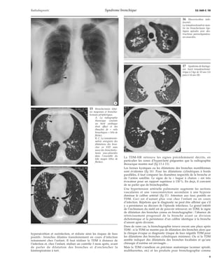 Radiodiagnostic Syndrome bronchique 32-360-C-10 
*A 
*B 
hypersécrétion et surinfection, et réduire ainsi les risques de faux 
positifs : bronches dilatées transitoirement en cours d’infection 
notamment chez l’enfant. Il faut réaliser la TDM à distance de 
l’infection et, chez l’enfant, réaliser un contrôle 3 mois après, avant 
de parler de dilatation des bronches et d’enclencher la 
kinérespiratoire à tort. 
La TDM-HR retrouve les signes précédemment décrits, en 
particulier les zones d’hyperclarté piégeantes que la radiographie 
thoracique montre mal (fig 13 à 15). 
Les formes kystiques ou les dilatations des bronches moniliformes 
sont évidentes (fig 16). Pour les dilatations cylindriques à bords 
parallèles, il faut comparer les diamètres respectifs de la bronche et 
de l’artère satellite. Le signe de la « bague à chaton » est très 
évocateur pour un rapport supérieur à 130 %. En deçà, il convient 
de ne parler que de bronchopathie. 
Une hypertension artérielle pulmonaire augmente les sections 
vasculaires et une vasoconstriction secondaire à une hypoxie 
diminue le calibre artériel (fig 11). Attention aux faux positifs en 
TDM. Ceci est d’autant plus vrai chez l’enfant ou en cours 
d’infection. Répétons que le diagnostic ne peut être affirmé que s’il 
y a persistance au décours de l’épisode infectieux. Le grand intérêt 
de l’inclinaison du statif est de pouvoir retrouver, en TDM, le signe 
de dilatation des bronches connu en bronchographie : l’absence de 
rétrécissement progressif de la bronche avant sa division 
dichotomique et la persistance d’un calibre identique à la bronche 
d’amont après division. 
Dans de rares cas, la bronchographie trouve encore une place après 
TDM : si la TDM ne montre pas de dilatation des bronches alors que 
la clinique évoque ce diagnostic (risque de faux négatifs TDM pour 
les dilatations des bronches cylindriques minimes). Ou si la TDM 
semble indiquer des dilatations des bronches focalisées et qu’une 
chirurgie d’exérèse est envisagée… 
Mais la TDM s’améliore en précision anatomique (scanner spiralé, 
multibarrettes, etc) et les produits pour bronchographie comme 
15 Bronchectasies lobai-res 
moyennes et bronchio-lectasies 
périphériques. 
A. La radiographie 
thoracique constate 
un bord cardiaque 
droit effacé et des 
ébauches de « rails 
bronchiques » (tête de 
flèche). 
B, C. La tomodensito-métrie 
enregistre des 
dilatations des bron-ches 
en S5D mais 
aussi des bronchiolec-tasies 
sous-pleurales 
dans l’ensemble du 
lobe moyen (têtes de 
flèches). 
*C 
16 Mucoviscidose (ado-lescent). 
La tomodensitométrie mon-tre 
les bronchectasies kys-tiques 
apicales avec des-tructions 
parenchymateu-ses 
associées. 
17 Syndrome de Kartage-ner. 
Suivi tomodensitomé-trique 
à l’âge de 10 ans (A) 
puis à 14 ans (B). 
*A 
*B 
9 
 