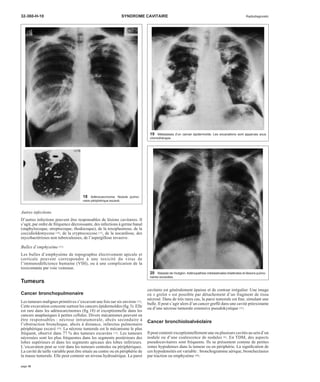 32-360-H-10 SYNDROME CAVITAIRE Radiodiagnostic 
Autres infections 
D’autres infections peuvent être responsables de lésions cavitaires. Il 
s’agit, par ordre de fréquence décroissante, des infections à germe banal 
(staphylocoque, streptocoque, rhodocoque), de la toxoplasmose, de la 
coccidioïdomycose [10], de la cryptococcose [15], de la nocardiose, des 
mycobactérioses non tuberculeuses, de l’aspergillose invasive. 
Bulles d’emphysème [51] 
Les bulles d’emphysème de topographie électivement apicale et 
corticale peuvent correspondre à une toxicité du virus de 
l’immunodéficience humaine (VIH), ou à une complication de la 
toxicomanie par voie veineuse. 
Tumeurs 
Cancer bronchopulmonaire 
Les tumeurs malignes primitives s’excavent une fois sur six environ [12]. 
Cette excavation concerne surtout les cancers épidermoïdes (fig 3). Elle 
est rare dans les adénocarcinomes (fig 18) et exceptionnelle dans les 
cancers anaplasiques à petites cellules. Divers mécanismes peuvent en 
être responsables : nécrose intratumorale, abcès secondaire à 
l’obstruction bronchique, abcès à distance, infarctus pulmonaire 
périphérique excavé [59]. La nécrose tumorale est le mécanisme le plus 
fréquent, observé dans 77 % des tumeurs excavées [12]. Les tumeurs 
nécrosées sont les plus fréquentes dans les segments postérieurs des 
lobes supérieurs et dans les segments apicaux des lobes inférieurs. 
L’excavation peut se voir dans les tumeurs centrales ou périphériques. 
La cavité de taille variable peut être située au centre ou en périphérie de 
la masse tumorale. Elle peut contenir un niveau hydroaérique. La paroi 
cavitaire est généralement épaisse et de contour irrégulier. Une image 
en « grelot » est possible par détachement d’un fragment de tissu 
nécrosé. Dans de très rares cas, la paroi tumorale est fine, simulant une 
bulle. Il peut s’agir alors d’un cancer greffé dans une cavité préexistante 
ou d’une nécrose tumorale extensive pseudokystique [22]. 
Cancer bronchioloalvéolaire 
Il peut contenir exceptionnellement une ou plusieurs cavités au sein d’un 
nodule ou d’une coalescence de nodules [8]. En TDM, des aspects 
pseudocavitaires sont fréquents. Ils se présentent comme de petites 
zones hypodenses dans la tumeur ou en périphérie. La signification de 
ces hypodensités est variable : bronchogramme aérique, bronchectasies 
par traction ou emphysème [48]. 
18 Adénocarcinome. Nodule pulmo-naire 
périphérique excavé. 
19 Métastases d’un cancer épidermoïde. Les excavations sont apparues sous 
chimiothérapie. 
20 Maladie de Hodgkin. Adénopathies médiastinales bilatérales et lésions pulmo-naires 
excavées. 
page 10 
 