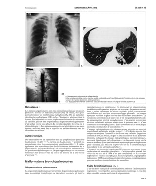 Radiodiagnostic SYNDROME CAVITAIRE 32-360-H-10 
A B 
Métastases [27] 
Les métastases pulmonaires sont plus rarement excavées que les cancers 
primitifs. Toutes les tumeurs peuvent être en cause, mais plus 
particulièrement les épithéliomas malpighiens (fig 19), en particulier 
otorhinolaryngologiques (ORL) chez l’homme et génitaux chez la 
femme. Les métastases excavées, et plus particulièrement les métastases 
de sarcome, peuvent être responsables d’un pneumothorax par rupture 
d’un nodule excavé sous-pleural. La cavitation peut être favorisée par la 
chimiothérapie [76]. Les métastases excavées ont généralement une paroi 
épaisse, mais une paroi fine et régulière est parfois observée dans les 
métastases de sarcome. 
Autres tumeurs 
Des excavations ont été rapportées dans les lymphomes en particulier 
hodgkiniens (fig 20) [57, 68], parfois non hodgkiniens [3] primitifs ou 
secondaires, dans la granulomatose lymphomatoïde [31]. Il existe 
également des excavations dans les localisations pulmonaires de la 
papillomatose laryngotrachéale [46], les pseudotumeurs inflammatoires 
ou granulomes à plasmocytes [58].On peut rapprocher de ces excavations 
tumorales les rares cavités au sein d’un nodule ou d’une masse 
d’amylose [36]. 
Malformations bronchopulmonaires 
Séquestrations pulmonaires 
La séquestration pulmonaire est un territoire de parenchyme pulmonaire 
sans connexion bronchique ou vasculaire normale et dont la 
vascularisation est systémique. On distingue les séquestrations 
intralobaires où le poumon séquestré est au contact du poumon normal, 
dans la même enveloppe de plèvre viscérale, et les séquestrations 
extralobaires qui ont leur propre enveloppe pleurale. Les images 
kystiques se voient le plus souvent dans les formes intralobaires. Le 
mécanisme de formation de ces kystes n’est pas parfaitement élucidé. 
Ils apparaissent en général secondairement. L’air pourrait provenir des 
alvéoles collatérales voisines situées dans le poumon sain [21], d’une 
communication oesophagienne, d’une communication bronchique 
anormale constituée lors d’une infection [26]. 
L’aspect radiographique des séquestrations est soit une opacité 
postérobasale unilatérale, soit des kystes [41, 67]. Ces kystes peuvent être 
uniques ou multiples. Leur taille et leur forme sont variables. Ils peuvent 
contenir de l’air, du mucus, du pus ou une association de ces différents 
éléments, expliquant les images radiographiques, purement aériques, 
purement liquidiennes ou hydroaériques. Le diagnostic repose sur la 
mise en évidence d’une vascularisation systémique par un ou plusieurs 
gros vaisseaux, qui naissent le plus souvent de l’aorte thoracique 
descendante et ont un trajet court (fig 21). 
L’imagerie par résonance magnétique (IRM) permet souvent une bonne 
exploration des anomalies vasculaires. L’artériographie pourrait être 
réservée aux cas où l’IRM n’est pas concluante [20]. Les autres 
explorations (transit oesophagien, bronchographie, angiographie 
pulmonaire,TDM) peuvent apporter des informations complémentaires 
pour une meilleure compréhension des anomalies. 
Kyste bronchogénique (fig 4) 
C’est un dérivé kystique de l’intestin primitif antérieur à différenciation 
respiratoire. Il reçoit parfois une vascularisation systémique et peut être 
alors considéré comme une forme de séquestration. 
21 
A. Séquestration pulmonaire de la base gauche. 
B. La tomodensitométrie montre bien les cavités multiples à paroi fine et fait suspecter l’existence d’un gros vaisseau 
naissant de l’aorte et à direction antéropostérieure. 
C. L’angiographie numérisée confirme la vascularisation de la lésion par un gros vaisseau systémique. 
C 
page 11 
 