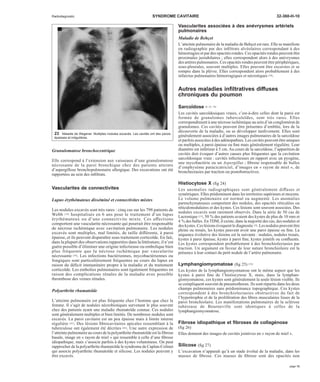 Radiodiagnostic SYNDROME CAVITAIRE 32-360-H-10 
Granulomatose bronchocentrique 
Elle correspond à l’extension aux vaisseaux d’une granulomatose 
nécrosante de la paroi bronchique chez des patients atteints 
d’aspergillose bronchopulmonaire allergique. Des excavations ont été 
rapportées au sein des infiltrats. 
Vascularites de connectivites 
Lupus érythémateux disséminé et connectivites mixtes 
Les nodules excavés sont très rares : cinq cas sur les 798 patients de 
Webb [78] hospitalisés en 6 ans pour le traitement d’un lupus 
érythémateux ou d’une connectivite mixte. Ces affections 
comportent une vascularite nécrosante qui pourrait être responsable 
de nécrose ischémique avec cavitation pulmonaire. Les nodules 
excavés sont multiples, mal limités, de taille différente, à paroi 
épaisse, et ils peuvent disparaître sous traitement corticoïde. En fait, 
dans la plupart des observations rapportées dans la littérature, il n’est 
guère possible d’éliminer une origine infectieuse ou embolique bien 
plus fréquente que la nécrose ischémique par vascularite 
nécrosante [78]. Les infections bactériennes, mycobactériennes ou 
fongiques sont particulièrement fréquentes au cours du lupus en 
raison du déficit immunitaire propre à la maladie et du traitement 
corticoïde. Les embolies pulmonaires sont également fréquentes en 
raison des complications rénales de la maladie avec possible 
thrombose des veines rénales. 
Polyarthrite rhumatoïde 
L’atteinte pulmonaire est plus fréquente chez l’homme que chez la 
femme. Il s’agit de nodules nécrobiotiques survenant le plus souvent 
chez des patients ayant une maladie rhumatoïde connue. Ces nodules 
sont généralement multiples et bien limités. De nombreux nodules sont 
excavés. La paroi cavitaire est un peu épaisse mais à limite interne 
régulière [42]. Des lésions fibrocavitaires apicales ressemblant à la 
tuberculose ont également été décrites [84]. Une autre expression de 
l’atteinte pulmonaire au cours de la polyarthrite rhumatoïde est la fibrose 
basale, image en « rayon de miel » qui ressemble à celle d’une fibrose 
idiopathique, mais s’associe parfois à des kystes volumineux. On peut 
rapprocher de la polyarthrite rhumatoïde le syndrome de Caplan-Colinet 
qui associe polyarthrite rhumatoïde et silicose. Les nodules peuvent y 
être excavés. 
Vascularites associées à des anévrysmes artériels 
pulmonaires 
Maladie de Behçet 
L’atteinte pulmonaire de la maladie de Behçet est rare. Elle se manifeste 
en radiographie par des infiltrats alvéolaires correspondant à des 
hémorragies et par des opacités rondes. Ces opacités rondes peuvent être 
proximales juxtahilaires ; elles correspondent alors à des anévrysmes 
des artères pulmonaires. Ces opacités rondes peuvent être périphériques, 
sous-pleurales, souvent multiples. Elles peuvent être excavées et se 
rompre dans la plèvre. Elles correspondent alors probablement à des 
infarctus pulmonaires hémorragiques et nécrotiques [34]. 
Autres maladies infiltratives diffuses 
chroniques du poumon 
Sarcoïdose [8, 63, 74] 
Les cavités sarcoïdosiques vraies, c’est-à-dire celles dont la paroi est 
formée de granulomes tuberculoïdes, sont très rares. Elles 
correspondraient à une nécrose ischémique au sein d’un conglomérat de 
granulomes. Ces cavités peuvent être présentes d’emblée, lors de la 
découverte de la maladie, ou se développer tardivement. Elles sont 
généralement associées à d’autres images pulmonaires de la sarcoïdose 
et parfois associées à des adénopathies. Les cavités peuvent être uniques 
ou multiples, à paroi épaisse ou fine mais généralement régulière. Leur 
diamètre est inférieur à 5 cm. Au cours de la sarcoïdose, l’apparition de 
cavités doit évoquer d’autres causes plus fréquentes que la cavitation 
sarcoïdosique vraie : cavités infectieuses en rapport avec un pyogène, 
une mycobactérie ou un Aspergillus ; fibrose responsable de bulles 
d’emphysème paracicatriciel, d’images en « rayon de miel », de 
bronchectasies par traction ou postobstructives. 
Histiocytose X (fig 24) 
Les anomalies radiographiques sont généralement diffuses et 
symétriques. Elles prédominent dans les territoires supérieurs et moyens. 
Le volume pulmonaire est normal ou augmenté. Les anomalies 
parenchymateuses comportent des nodules, des opacités réticulées ou 
réticulonodulaires et des kystes. Ces lésions sont souvent associées. Des 
nodules excavés sont rarement observés. Dans la série de 50 cas de 
Lacronique [53], 50 % des patients avaient des kystes de plus de 10 mm et 
4 %des bulles. En TDM, il existe, dans la majorité des cas, des nodules et 
des kystes. Ces lésions évoquent le diagnostic [9]. Les nodules peuvent être 
pleins ou troués, les kystes peuvent avoir une paroi épaisse ou fine. La 
séquence évolutive des lésions est la suivante : nodules, nodules troués, 
kystes à paroi épaisse, kystes à paroi fine, kystes jointifs ou confluents. 
Les kystes correspondent probablement à des bronchiolectasies par 
traction. Un argument en faveur de leur nature bronchiolaire est la 
présence à leur contact du petit nodule de l’artère pulmonaire. 
Lymphangiomyomatose (fig 25) [54] 
Les kystes de la lymphangiomyomatose ont le même aspect que les 
kystes à paroi fine de l’histiocytose X, mais, dans la lymphan-giomyomatose, 
ces kystes sont généralement la seule lésion visible. Ils 
se compliquent souvent de pneumothorax. Ils sont répartis dans les deux 
champs pulmonaires sans prédominance topographique. Ces kystes 
correspondent à des bronchiolectasies obstructives du fait de 
l’hypertrophie et de la prolifération des fibres musculaires lisses de la 
paroi bronchiolaire. Les manifestations pulmonaires de la sclérose 
tubéreuse de Bourneville sont identiques à celles de la 
lymphangiomyomatose. 
Fibrose idiopathique et fibroses de collagénose 
(fig 26) 
Elles donnent des images de cavités jointives en « rayon de miel ». 
Silicose (fig 27) 
L’excavation n’apparaît qu’à un stade évolué de la maladie, dans les 
masses de fibrose. Ces masses de fibrose sont des opacités non 
23 Maladie de Wegener. Multiples nodules excavés. Les cavités ont des parois 
épaisses et irrégulières. 
page 13 
 