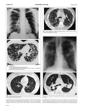 32-360-H-10 SYNDROME CAVITAIRE Radiodiagnostic 
A 
B 
systématisées, souvent de grande taille, à limite externe nette et à limite 
interne mal définie. Initialement périphériques, elles se rapprochent 
progressivement des hiles. Elles sont souvent entourées de bulles 
27 Silicose. Masses de fibrose périhilaire bilatérales. La masse de fibrose droite est 
excavée. 
d’emphysème. Elles peuvent s’excaver, le plus souvent du fait d’une 
nécrose aseptique, parfois du fait d’une surinfection. Il existe alors une 
cavité centrale à paroi épaisse pouvant contenir un niveau hydroaérique. 
24 Histiocytose X. 
A. Image radiographique réticulée et kystique. 
B. La tomodensitométrie met en évidence des nodules « troués », des kystes à 
paroi épaisse et des kystes à paroi fine. 
25 Lymphangiomyomatose pulmonaire. Nombreux kystes à paroi fine disséminés 
dans les deux champs pulmonaires. 
26 Fibrose idiopathique. Images cavitaires jointives en « rayon de miel » prédomi-nant 
dans la périphérie du poumon. 
page 14 
 