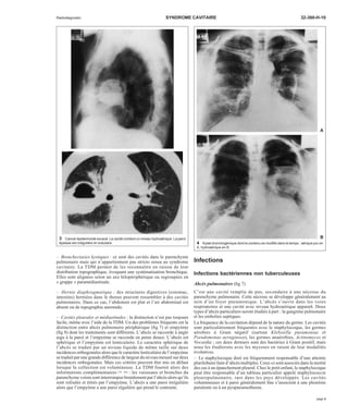 Radiodiagnostic SYNDROME CAVITAIRE 32-360-H-10 
A 
B 
3 Cancer épidermoïde excavé. La cavité contient un niveau hydroaérique. La paroi 
épaisse est irrégulière et nodulaire. 4 Kyste bronchogénique dont le contenu se modifie dans le temps : aérique pur en 
– Bronchectasies kystiques : ce sont des cavités dans le parenchyme 
pulmonaire mais qui n’appartiennent pas stricto sensu au syndrome 
cavitaire. La TDM permet de les reconnaître en raison de leur 
distribution topographique, évoquant une systématisation bronchique. 
Elles sont alignées selon un axe hilopériphérique ou regroupées en 
« grappe » paramédiastinale. 
– Hernie diaphragmatique : des structures digestives (estomac, 
intestins) herniées dans le thorax peuvent ressembler à des cavités 
pulmonaires. Dans ce cas, l’abdomen est plat et l’air abdominal est 
absent ou de topographie anormale. 
– Cavités pleurales et médiastinales : la distinction n’est pas toujours 
facile, même avec l’aide de la TDM. Un des problèmes fréquents est la 
distinction entre abcès pulmonaire périphérique (fig 7) et empyème 
(fig 8) dont les traitements sont différents. L’abcès se raccorde à angle 
aigu à la paroi et l’empyème se raccorde en pente douce. L’abcès est 
sphérique et l’empyème est lenticulaire. Le caractère sphérique de 
l’abcès se traduit par un niveau liquide de même taille sur deux 
incidences orthogonales alors que le caractère lenticulaire de l’empyème 
se traduit par une grande différence de largeur du niveau mesuré sur deux 
incidences orthogonales. Mais ces critères peuvent être mis en défaut 
lorsque la collection est volumineuse. La TDM fournit alors des 
informations complémentaires [70, 80] : les vaisseaux et bronches du 
parenchyme voisin sont interrompus brutalement par l’abcès alors qu’ils 
sont refoulés et étirés par l’empyème. L’abcès a une paroi irrégulière 
alors que l’empyème a une paroi régulière qui prend le contraste. 
A, hydroaérique en B. 
Infections 
Infections bactériennes non tuberculeuses 
Abcès pulmonaires (fig 7) 
C’est une cavité remplie de pus, secondaire à une nécrose du 
parenchyme pulmonaire. Cette nécrose se développe généralement au 
sein d’un foyer pneumonique. L’abcès s’ouvre dans les voies 
respiratoires et une cavité avec niveau hydroaérique apparaît. Deux 
types d’abcès particuliers seront étudiés à part : la gangrène pulmonaire 
et les embolies septiques. 
La fréquence de la cavitation dépend de la nature du germe. Les cavités 
sont particulièrement fréquentes avec le staphylocoque, les germes 
aérobies à Gram négatif (surtout Klebsiella pneumoniae et 
Pseudomonas aeruginosa), les germes anaérobies, Actinomyces et 
Nocardia ; ces deux derniers sont des bactéries à Gram positif, mais 
nous les étudierons avec les mycoses en raison de leur modalités 
évolutives. 
– Le staphylocoque doré est fréquemment responsable d’une atteinte 
plurilobaire faite d’abcès multiples. Ceux-ci sont associés dans la moitié 
des cas à un épanchement pleural. Chez le petit enfant, le staphylocoque 
peut être responsable d’un tableau particulier appelé staphylococcie 
pleuropulmonaire, rare dans les pays développés. Les cavités 
volumineuses et à paroi généralement fine s’associent à une pleurésie 
purulente ou à un pyopneumothorax. 
page 3 
 