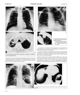 32-360-H-10 SYNDROME CAVITAIRE Radiodiagnostic 
A 
B 
– Klebsiella pneumoniae (bacille de Friedlander) survient surtout chez 
l’éthylique et peut être responsable d’une nécrose précoce et extensive 
se développant dans une pneumonie systématisée lobaire à limites 
parfois convexes (bombement des scissures). 
A 
6 Aspergillose invasive. Fièvre pro-longée 
chez un patient sortant de son 
aplasie thérapeutique. 
A. Nodules pulmonaires multiples. 
B. La tomodensitométrie montre 
des « croissants » gazeux dans 
ces nodules. 
B 
– Pseudomonas aeruginosa (pyocyanique) est responsable de 
pneumopathies nosocomiales souvent bilatérales et plurifocales. Les 
complications pleurales sont fréquentes. 
– Les germes anaérobies compliquent fréquemment une pneumopathie 
d’inhalation et sont donc responsables d’une atteinte localisée basale 
surtout droite. La pleurésie purulente, présente dans la moitié des cas, 
peut masquer l’atteinte pulmonaire. 
L’abcès est le plus souvent unique, parfois multiple. La cavité a une 
limite interne irrégulière. La limite externe est peu visible, masquée par 
la pneumonie. L’épaisseur de la paroi n’est le plus souvent pas 
mesurable. Dans quelques cas, il existe une topographie préférentielle : 
atteinte élective des lobes inférieurs dans les troubles de la déglutition, 
5 Cavité apicale droite séquellaire de tuberculose contenant un aspergillome : 
opacité intracavitaire déclive et mobile suspectée par la radiographie (A) et affirmée 
par la tomodensitométrie (B). 
7 Abcès pulmonaire. L’abcès se raccorde à angle aigu à la paroi thoracique et sa paroi est 
irrégulière. 
page 4 
 