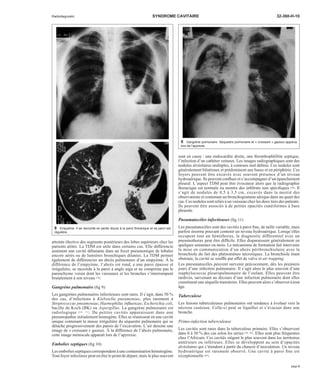 Radiodiagnostic SYNDROME CAVITAIRE 32-360-H-10 
atteinte élective des segments postérieurs des lobes supérieurs chez les 
patients alités. La TDM est utile dans certains cas. Elle différencie 
aisément une cavité débutante dans un foyer pneumonique de lobules 
encore aérés ou de lumières bronchiques dilatées. La TDM permet 
également de différencier un abcès pulmonaire d’un empyème. À la 
différence de l’empyème, l’abcès est rond, a une paroi épaisse et 
irrégulière, se raccorde à la paroi à angle aigu et ne comprime pas le 
parenchyme voisin dont les vaisseaux et les bronches s’interrompent 
brutalement à son niveau [70]. 
Gangrène pulmonaire (fig 9) 
Les gangrènes pulmonaires infectieuses sont rares. Il s’agit, dans 50 % 
des cas, d’infections à Klebsiella pneumoniae, plus rarement à 
Streptococcus pneumoniae, Haemophilus influenzae, Escherichia coli, 
bacille de Koch (BK) ou Aspergillus. La gangrène pulmonaire est 
radiologique [52, 71]. De petites cavités apparaissent dans une 
pneumopathie initialement homogène. Elles se réunissent en une cavité 
unique contenant la masse irrégulière du séquestre pulmonaire qui se 
détache progressivement des parois de l’excavation. L’air dessine une 
image de « croissant » gazeux. À la différence de l’abcès pulmonaire, 
cette image méniscale apparaît lors de l’apyrexie. 
Embolies septiques (fig 10) 
Les embolies septiques correspondent à une contamination hématogène. 
Tout foyer infectieux peut en être le point de départ, mais le plus souvent 
sont en cause : une endocardite droite, une thrombophlébite septique, 
l’infection d’un cathéter veineux. Les images radiographiques sont des 
nodules alvéolaires multiples, à contours mal définis. Ces nodules sont 
généralement bilatéraux et prédominent aux bases et en périphérie. Ces 
foyers peuvent être excavés avec souvent présence d’un niveau 
hydroaérique. Ils peuvent confluer et s’accompagner d’un épanchement 
pleural. L’aspect TDM peut être évocateur alors que la radiographie 
thoracique est normale ou montre des infiltrats non spécifiques [50]. Il 
s’agit de nodules de 0,5 à 3,5 cm, excavés dans la moitié des 
observations et contenant un bronchogramme aérique dans un quart des 
cas. Ces nodules sont reliés à un vaisseau chez les deux tiers des patients. 
Ils peuvent être associés à de petites opacités cunéiformes à base 
pleurale. 
Pneumatocèles infectieuses (fig 11) 
Les pneumatocèles sont des cavités à paroi fine, de taille variable, mais 
parfois énorme pouvant contenir un niveau hydroaérique. Lorsqu’elles 
occupent tout un hémithorax, le diagnostic différentiel avec un 
pneumothorax peut être difficile. Elles disparaissent généralement en 
quelques semaines ou mois. Le mécanisme de formation fait intervenir 
la mise en communication d’un abcès péribronchiolaire avec la 
bronchiole du fait des phénomènes nécrotiques. La bronchiole étant 
obstruée, la cavité se souffle par effet de valve et air trapping. 
Les pneumatocèles peuvent survenir précocement, dès les premiers 
jours d’une infection pulmonaire. Il s’agit alors le plus souvent d’une 
staphylococcie pleuropulmonaire de l’enfant. Elles peuvent être 
tardives, survenant au décours d’une infection pulmonaire dont elles 
constituent une séquelle transitoire. Elles peuvent alors s’observer à tout 
âge. 
Tuberculose 
Les lésions tuberculeuses pulmonaires ont tendance à évoluer vers la 
nécrose caséeuse. Celle-ci peut se liquéfier et s’évacuer dans une 
bronche. 
Primo-infection tuberculeuse 
Les cavités sont rares dans la tuberculose primaire. Elles s’observent 
dans 0 à 30%des cas selon les séries [79, 83]. Elles sont plus fréquentes 
chez l’Africain. Ces cavités siègent le plus souvent dans les territoires 
antérieurs ou inférieurs. Elles se développent au sein d’opacités 
alvéolaires qui s’étendent à partir du chancre d’inoculation. Un niveau 
hydroaérique est rarement observé. Une cavité à paroi fine est 
exceptionnelle [83]. 
8 Empyème. Il se raccorde en pente douce à la paroi thoracique et sa paroi est 
régulière. 
9 Gangrène pulmonaire. Séquestre pulmonaire et « croissant » gazeux apparus 
lors de l’apyrexie. 
page 5 
 
