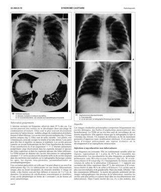32-360-H-10 SYNDROME CAVITAIRE Radiodiagnostic 
Tuberculose postprimaire 
L’atteinte cavitaire est fréquente, observée dans 45 % des cas. Les 
cavités peuvent être isolées ou se développer dans une plage de 
condensation alvéolaire. Elles sont le plus souvent diversement 
associées à d’autres lésions : nodules, plages de condensation alvéolaire, 
lésions d’allure fibreuse. Les cavités sont souvent multiples (fig 12) mais 
parfois uniques (fig 1). Elles sont de taille variable : soit petites, soit 
volumineuses, pouvant occuper la totalité d’un lobe détruit. Leur paroi 
peut être fine et régulière ou épaisse et nodulaire. Les cavités peuvent 
contenir un niveau hydroaérique du fait d’une liquéfaction du caséum, 
d’une surinfection ou d’un saignement [16, 83]. L’atteinte pulmonaire 
postprimaire siège électivement dans les segments dorsaux et apicaux 
des lobes supérieurs et dans les segments apicaux des lobes inférieurs. 
La TDM permet de dépister des cavités méconnues en radiographie 
standard [47]. C’est le cas des cavités de petite taille ou de cavités siégeant 
dans des territoires mal explorés sur la radiographie thoracique comme 
les apex, les régions sous-pleurales, juxtamédiastinales ou 
juxtadiaphragmatiques. 
Une cavitation particulière est celle que l’on peut observer au sein d’un 
tuberculome (fig 13). Le tuberculome est une lésion fibrocaséeuse 
unique, plus ou moins encapsulée, de structure stratifiée. L’image est 
ronde, a des limites souvent bien définies et mesure de 1 à 5 cm de 
diamètre. La présence de calcifications concentriques et stratifiées, 
d’une cavité périphérique en forme de « croissant » ou de fissure est 
assez caractéristique. 
Séquelles 
Les images résiduelles polymorphes comportent fréquemment des 
cavités détergées, des bulles d’emphysème paracicatriciel, des 
bronchectasies. La TDM est un très bon outil de surveillance de ces 
lésions séquellaires. Elle apprécie mieux que la radiographie le type et 
l’étendue des lésions. Un examen de référence en fin de traitement 
permettra d’apprécier toute modification ultérieure. Il est ainsi plus 
facile d’évoquer précocement une reprise évolutive ou le 
développement d’un aspergillome intracavitaire. 
Infections à mycobactéries non tuberculeuses 
Leur fréquence est croissante. Elle est extrêmement variable selon les 
régions, représentant de 1 à plus de 50 % de l’ensemble des 
mycobactéries. Les mycobactéries les plus fréquentes en pathologie 
pulmonaire sont Mycobacterium kansasii (fig 14), M avium-intracellulare 
et M xenopi (fig 15). Classiquement, les lésions sont très 
voisines de celles de la tuberculose. Christensen [13, 14] rapporte une 
cavitation des lobes supérieurs dans 87 % des infections à M avium-intracellulare 
et dans 96 % de celles à M kansasii. Ces cavités sont le 
plus souvent multiples et de grande taille. Dans une étude,Albelda [2] fait 
des constatations différentes : la moitié des patients seulement ont des 
images radiographiques très proches de la tuberculose, toutefois les 
cavités sont plus petites et à parois fines dans les mycobactérioses non 
tuberculeuses. Dans l’autre moitié des cas, il y a des nodules, des 
10 Embolies septiques. 
A. Nodules multiples à contours mal définis. 
B. En tomodensitométrie, ces nodules sont périphériques et excavés. 
A 
B 
11 Staphylococcie pleuropulmonaire. 
A. Pneumatocèle. 
B. Un an plus tard, la radiographie thoracique est normale. 
A 
B 
page 6 
 