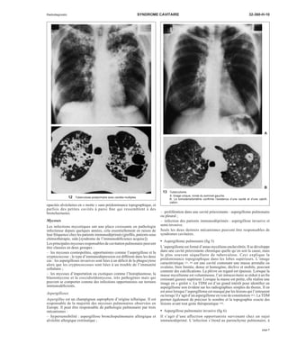 Radiodiagnostic SYNDROME CAVITAIRE 32-360-H-10 
opacités alvéolaires en « motte » sans prédominance topographique, et 
parfois des petites cavités à paroi fine qui ressemblent à des 
bronchectasies. 
Mycoses 
Les infections mycotiques ont une place croissante en pathologie 
infectieuse depuis quelques années, cela essentiellement en raison de 
leur fréquence chez les patients immunodéprimés (greffés, patients sous 
chimiothérapie, sida [syndrome de l’immunodéficience acquise]). 
Les principales mycoses responsables de cavitation pulmonaire peuvent 
être classées en deux groupes : 
– les mycoses cosmopolites, opportunistes comme l’aspergillose et la 
cryptococcose ; le type d’immunodépression est différent dans les deux 
cas : les aspergilloses invasives sont liées à un déficit de la phagocytose 
alors que les cryptococcoses sont liées à un trouble de l’immunité 
cellulaire ; 
– les mycoses d’importation ou exotiques comme l’histoplasmose, la 
blastomycose et la coccidioïdomycose, très pathogènes mais qui 
peuvent se comporter comme des infections opportunistes sur terrains 
immunodéficients. 
Aspergilloses 
Aspergillus est un champignon saprophyte d’origine tellurique. Il est 
responsable de la majorité des mycoses pulmonaires observées en 
Europe. Il peut être responsable de pathologie pulmonaire par trois 
mécanismes : 
– hypersensibilité : aspergillose bronchopulmonaire allergique et 
alvéolite allergique extrinsèque ; 
A 
B 
– prolifération dans une cavité préexistante : aspergillome pulmonaire 
ou pleural ; 
– infection des patients immunodéprimés : aspergillose invasive et 
semi-invasive. 
Seuls les deux derniers mécanismes peuvent être responsables de 
syndromes cavitaires. 
· Aspergillome pulmonaire (fig 5) 
L’aspergillome est formé d’amas mycéliens enchevêtrés. Il se développe 
dans une cavité préexistante chronique quelle qu’en soit la cause, mais 
le plus souvent séquellaire de tuberculose. Ceci explique la 
prédominance topographique dans les lobes supérieurs. L’image 
caractéristique [33, 44] est une cavité contenant une masse arrondie ou 
ovalaire, bien limitée, dense et homogène, déclive et mobile, pouvant 
contenir des calcifications. La plèvre en regard est épaissie. Lorsque la 
masse mycélienne est volumineuse, l’air intracavitaire se réduit à un fin 
croissant gazeux supérieur. Lorsque la masse est petite, elle réalise une 
image en « grelot ». La TDM est d’un grand intérêt pour identifier un 
aspergillome non évident sur les radiographies simples du thorax. Il en 
est ainsi lorsque l’aspergillome est masqué par les lésions qui l’entourent 
ou lorsqu’il s’agit d’un aspergillome en voie de constitution [62]. LaTDM 
permet également de préciser le nombre et la topographie exacte des 
lésions avant tout geste thérapeutique [30]. 
· Aspergillose pulmonaire invasive (fig 6) 
Il s’agit d’une affection opportuniste survenant chez un sujet 
immunodéprimé. L’infection s’étend au parenchyme pulmonaire, à 
12 Tuberculose postprimaire avec cavités multiples. 
13 Tuberculome. 
A. Image unique, ronde du sommet gauche. 
B. La tomodensitométrie confirme l’existence d’une cavité et d’une calcifi-cation. 
page 7 
 