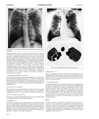 32-360-H-10 SYNDROME CAVITAIRE Radiodiagnostic 
partir des bronches, sans qu’il y ait de cavité préexistante. Le tropisme 
vasculaire d’Aspergillus entraîne une nécrose et une cavitation 
secondaire. L’aspergillose pulmonaire invasive se manifeste au début 
par une ou plusieurs opacités alvéolaires arrondies, à contours mal 
définis mesurant de un à quelques centimètres de diamètre. La présence 
enTDMd’un halo d’hyperdensité en « verre dépoli » autour de l’opacité 
alvéolaire serait évocatrice du diagnostic et annoncerait la cavitation [49]. 
La cavitation ne survient que dans 50 % des cas [28]. Elle est retardée, 
survenant en moyenne 15 jours après les premiers signes 
radiographiques et serait liée à la correction de la leucopénie. 
L’apparition retardée de la cavitation en limite la valeur diagnostique. 
Cette cavité contient le plus souvent un nodule mural [37], séquestre de 
parenchyme nécrosé fixé à la paroi, responsable d’images en 
« croissant » ou en « cible » selon que le nodule est tangent au 
rayonnement ou vu de face. 
· Aspergillose pulmonaire semi-invasive 
Elle survient chez des patients peu immunodéprimés, souvent atteints 
de bronchopneumopathies chroniques. Le tableau est celui d’une 
pneumopathie nécrosante fébrile d’évolution progressive avec altération 
de l’état général. En radiographie, des cavités apparaissent dans les 
opacités alvéolaires. Les cavités contiennent des masses identiques aux 
aspergillomes [29]. 
Autres mycoses cosmopolites 
Elles sont plus rares que l’aspergillose. La cryptococcose est rarement 
responsable de cavitation [18]. La mucormycose [56] ressemble à 
l’aspergillose invasive [55]. La sporotrichose ressemble à la tuberculose. 
Mycoses exotiques d’importation 
Les mycoses exotiques d’importation peuvent se voir en France du fait 
de l’augmentation des voyages intercontinentaux. 
· Histoplasmose [24] 
Histoplasma capsulatum d’origine américaine est beaucoup plus 
souvent responsable d’atteinte pulmonaire que H duboisii d’origine 
africaine. L’histoplasmose pulmonaire ressemble à la tuberculose. La 
phase chronique résulte soit du prolongement de la primo-infection 
pulmonaire, soit d’une réinfection. Elle se manifeste par des opacités 
alvéolaires souvent excavées, pouvant être associées à des nodules, des 
opacités en « bandes », des signes de rétraction. 
· Blastomycose [39, 69] 
Elle est responsable d’opacités alvéolaires systématisées ou non, 
atteignant un lobe supérieur ou plusieurs lobes. Des adénopathies ou une 
atteinte pleurale s’y associent parfois. Des cavités peuvent être 
observées au sein des opacités alvéolaires dans un quart des cas environ 
(10 à 37 % selon les séries). 
· Coccidioïdomycose [6] 
Une cavitation peut être observée en phase aiguë. La cavité apparaît dans 
une plage de condensation alvéolaire. L’évolution est habituellement 
favorable avec régression des images radiographiques. Mais les cavités 
peuvent persister. Elles sont uniques dans 90 % des cas. Elles 
prédominent dans les lobes supérieurs et en topographie sous-pleurale. 
Elles sont souvent petites (2 à 4 cm) et à paroi fine. Dans la moitié des 
cas, elles disparaissent en 2 ans ; dans l’autre moitié, elles persistent 
souvent stables et non compliquées. Néanmoins, elles peuvent se 
compliquer de mycétome, de surinfection à pyogènes ou de 
pyopneumothorax. 
Divers 
Certaines bactéries cosmopolites, comme les actinomycètes et 
Nocardia, ont des manifestations pulmonaires, proches de celles des 
mycoses. L’actinomycose pulmonaire est responsable d’opacités 
alvéolaires uniques ou multiples non systématisées, évoluant vers 
l’excavation et la rétraction. L’infection peut s’étendre à la paroi. La 
nocardiose donne des plages de condensation et de gros nodules 
irréguliers souvent excavés [19]. 
14 Infection à Mycobacterium kansasii. Cavités à parois fines dans les deux lobes 
supérieurs. 
15 Infection à Mycobacterium xenopi. Cavité de l’apex droit. 
page 8 
 